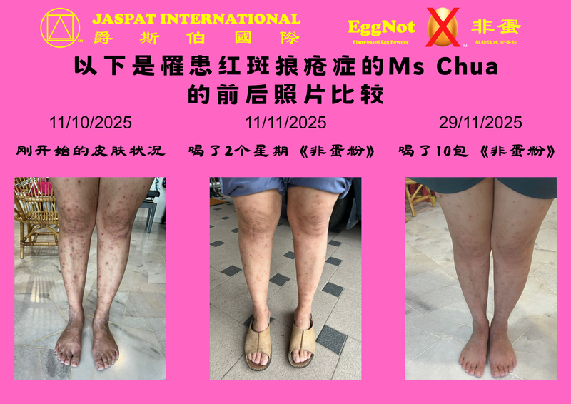 This is the latest skin condition update from Ms. Chua, <br>a customer with lupus. <br>Ms. Chua has suffered for more than ten years, <br>and despite seeking treatment from both Western and Chinese medicine, nothing worked. <br>But in just one month and one week, <br>thanks to 《EggNot》, <br>she has experienced a remarkable recovery. <br>👍 Another miracle has happened once again‼️ <br>Grateful 🙏🏻 grateful 💞 and grateful again 😇 <br>#EggNotPowder #EggNotGoldenNoodles #Testimony #HeartHealth #RecoveryJourney #lupus #VascularHealth #NaturalNutrition #PlantBased #Singapore #Malaysia #HealthMiracle #familyhealth <br>这是红斑狼疮症的顾客Ms Chua的最新皮肤状况。 <br> Ms Chua十多年来的痛楚，看了西医又看中医都治不好，<br>但在短短一个月又一个星期的时间，<br>因为《非蛋粉》的缘故，<br>得以显著康复的效果👍  <br>奇迹又再次发生‼️  <br>感恩🙏🏻感恩💞再感恩😇 <br>#非蛋粉 #非蛋黄金面 #健康见证 #康复 #植物营养 #红斑狼疮#心脏健康 #血管疏通 #孝心 #奇迹 #马来西亚