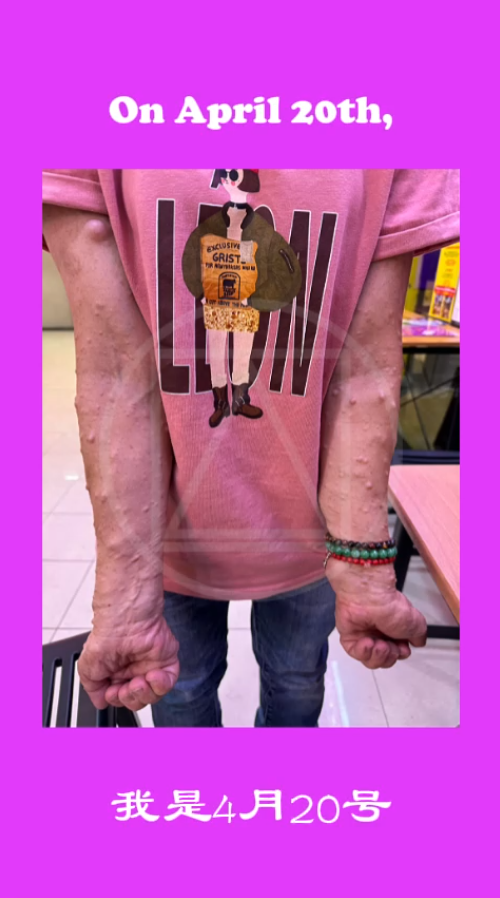 Singapore 🇸🇬 <br>【JASPAT INTERNATIONAL】<br> U-Turn Point F&B <br>We have some wonderful news to share! <br>Meet our loyal customer, Lydia. <br>She developed a skin condition in her 20s, which caused many fleshy growths on her body. <br>Fortunately, on April 20th, she came across our booth in Tampines and discovered our 《EggNot Powder》. <br>She bought a few packs back then.  <br>After drinking it for a month, she felt much better and even noticed her hands became stronger for work! <br>She has kept drinking it since. Recently, she went for a medical check-up, and the doctor told her that her liver health index has improved for the first time! Her cholesterol level has also dropped! <br>That's why she decided to buy 20 packs of 《EggNot Powder》 all at once! <br>After learning about our store, she made a special trip down to share her story and film this testimonial video with us. She believes that sharing these testimonials can help save lives. <br>Every story shared could potentially help to save lives. <br>Salute to Lydia,  <br>one of our 【JASPAT】 H.E.R.O. 🫡 <br>Thank you 🙏 Thank you💞 and Thank you😇 <br>This all happened at <br>【JASPAT INTERNATIONAL】 <br>U-Turn Point F&B. <br>Please visit us now at: <br>📍 Fortune Centre, 02-20A <br><br>新加坡 🇸🇬 <br>【爵斯伯国际】 U-转点餐饮 <br>又迎来一则好消息！ <br>向大家介绍我们的忠实顾客Lydia。 <br>她在20多岁时突然患上皮肤病，全身长了许多肉瘤。 <br>很幸运地，在4月20号那天，她在淡滨尼遇到了咱们，并认识了《非蛋粉》。 <br>当时她买了几包《非蛋粉》回去。喝了一个月后，她反馈说感觉身体很不错，连手都变得更有力气做工了！ <br>她一直坚持喝到现在。<br>最近她去做身体检查，医生告诉她，她的肝脏健康指数第一次改善了！胆固醇也下降了！ <br>所以她这次一口气跟我们买了20包《非蛋粉》！ <br>在知道咱们的门店后，她特地来找咱们，分享这个故事，并拍了这个见证影片！因为她深信，分享《见证》就是在救人。 <br>多一个故事分享出去， <br>就可能救多一个人的命。 <br>【爵斯伯】英雄是也。🫡 感恩🙏感恩💞再感恩😇 <br>这一切都发生在【爵斯伯国际】U-转点餐饮。 <br>欢迎光临我们的门店： <br>📍 地址：金隆大厦, 02-20A <br><br>#AWorldFirst #FuturisticDining #JaspatInternational #SingaporeFood #HighNutritiousWithFibre #EggNotPowder #Testimonial #未来式餐饮 #爵斯伯国际 #新加坡美食 #高营养含纤维 #非蛋粉 #顾客见证