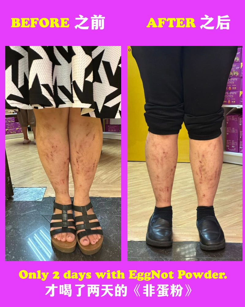 Great news! Great news! <br>Singapore 🇸🇬【JASPAT International】 U-Turn Point F&B welcomed a customer.<br> As soon as she arrived, she asked loudly: "Look at my feet like this (eczema)! Can you cure it? My feet are extremely itchy, and it has been bothering me for over a year. I’ve seen many doctors—both Western and Chinese medicine practitioners. <br>I’ve taken a lot of medication and spent a lot of money, but it still hasn't gotten better. Can you heal my feet?" We quickly replied: "We are not doctors! This is not a clinic! We sell food here. This 《EggNot》 powder is not medicine! It's not a health supplement either! It's just food<br>—functional food with diet therapy." <br>Then we also shared with her some recent miraculous testimonials— one about lupus, and another about a 73-year-old with severe cardiovascular blockages and acute kidney failure who made a miraculous recovery. After hearing this, she said with great confidence that she wanted to try our 《EggNot》 products. <br>After that, she bought 《EggNot》 powder and 《Golden Noodles》, and happily took them home! <br>Two days later, she came back again! She was very excited and said right away: "Look, my feet have improved! I drink the 《EggNot》 powder two to three times a day, and I eat the 《Golden Noodles》 every night. I never expected that in just two days, after taking the 《EggNot》 products, the itching has stopped. Look, the original wounds on my feet have dried up naturally, the dried skin has fallen off on its own, and now I'm just waiting for the scars to fade! It's amazing!" Later, she proactively said: "Quick, help me record a testimonial! I want to share this with more people!" Salute to this consumer— One of our【JASPAT】H.E.R.O 📱 Welcome to WhatsApp us:  SG  +65 8054 1983 MY  +6014-2245663 📍 Or visit our outlet: Fortune Centre #02-20A Opening Hours: 10am – 8pm daily Closed on Tuesdays, except when the 1st or 15th of the lunar month falls on a Tuesday. In such cases, we will operate on Tuesday and close the following day instead.<br> 好消息！好消息！ 新加坡🇸🇬 【爵斯伯国际】 U-转点餐饮 迎来了一位顾客 她一来就很大声的问道： “你看，我的脚这样（湿疹）！你们可以医好吗？ 我的脚非常痒，已经困扰我一年了，我看了很多的医生，西医也看了，中医也看了，吃了很多药，烧了很多钱还是不能好，你们可以医好我的脚吗？” 我们连忙回答： “我们不是医生！ 我们这里不是诊所！我们这里是卖吃的，这个《非蛋》粉也不是药！也不是保健品！它就是食物，是功能性食疗食品。 然后我们也一直跟她分享最近的神奇见证— 红斑狼疮的见证，和73岁严重心血管阻塞和急性肾衰竭 起死回生的见证。 听完后，她就很有信心的说，她要尝试我们的《非蛋》产品。后来她买《非蛋》粉和《黄金面》，很开心的带回家！ 过了两天， 她又回来了！ 她很兴奋的，一来就说你看我的脚有改善了！ 我一天喝两到三次的《非蛋》粉， 也每一晚吃《黄金面》， 没想到只是两天而已， 吃了《非蛋》产品后，脚不痒了， 你看我的脚原本的伤口，自然的干了， 那个干掉的皮也自己掉落， 现在只是等那些印疤恢复而已！ 太神奇了！” 后来她很主动的说： “赶快，帮我拍见证！ 我要分享给更多人知道！” 向这位顾客 【爵斯伯】英雄致敬 📍 欢迎📱 WhatsApp我们： SG  +65 8054 1983 MY  +6014-2245663 📍  欢迎亲临门店： 金隆大厦 #02-20A 营业时间：每日上午10点 – 晚上8点 每周二休息。若农历初一或十五适逢周二，则该周二照常营业，并于次日休息。 期待为您服务！