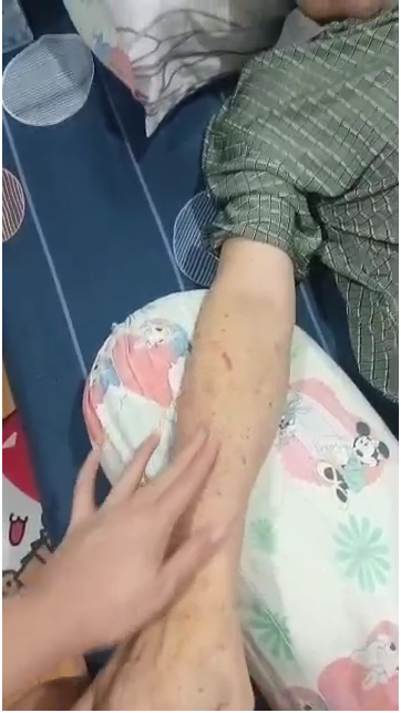 A testimony that moved us to tears. <br>🙏 From critical condition to reclaiming his independence. 🕊️ Mr. Lee's 73yo father-in-law was sent home from the hospital with no hope after being rejected for heart surgery.  He fell into a coma due to 95% vascular blockages & acute kidney failure. With no other options, his family gave him 《EggNot》powder & 《EggNot》 Golden Noodles. In just 8-9 days: <br>➡️ Severe bruising GONE, skin became fair & smooth <br>➡️ Regained strength to WALK alone with his walking stick to the bathroom in the middle of the night. <br>➡️ Successfully detoxed <br>➡️ Energy & spirit SKYROCKETED This plant-based nutrition helped him take the steps doctors said might not be possible. <br>❤️ Ready to explore your path to wellness? <br>Visit us today at: 📍 Fortune Centre, 02-20A <br>Or contact us: SG: +65 8054 1983 MY: +60 14-224 5663 <br>#EggNotPowder #EggNotGoldenNoodles #Testimony #HeartHealth #RecoveryJourney #VascularHealth #NaturalNutrition #PlantBased #Singapore #Malaysia #HealthMiracle #FamilyHealth <br>一份让我们感动落泪的见证。<br>🙏 从病危到重获行动力。🕊️ 李先生的73岁岳父因心脏手术被拒，医院束手无策。因血管95%阻塞及急性肾衰竭，他曾陷入昏迷。 在没有选择之下，家人让他尝试了 《非蛋粉》 和 《非蛋》黄金面。 短短8-9天内：<br> ➡️ 严重淤青完全消失，皮肤变白皙嫩滑 <br>➡️ 恢复体力，能借助拐杖 大半夜自行行走到厕所 <br>➡️ 成功排出毒素 <br>➡️ 精神气色大好 植物营养支持他，走出了医生认为不可能的一步。<br>❤️ 准备开始您的健康之旅了吗？<br> 欢迎光临我们的门店： <br>📍 地址：金隆大厦, 02-20A 或联系我们：<br> 新加坡: +65 8054 1983 马来西亚: +60 14-224 5663 <br>#非蛋粉 #非蛋黄金面 #健康见证 #康复 #植物营养 #心脏健康 #血管疏通 #孝心 #奇迹 #马来西亚