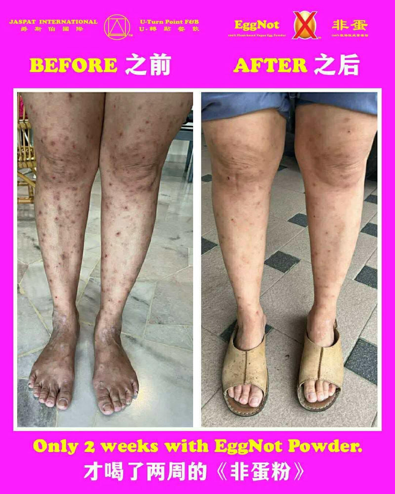 【JASPAT INTERNATIONAL】U-Turn Point F&B We have some wonderful news to share! <br>Meet our loyal customer, Ms. Chua. Since young, she has been battling Lupus - a challenging autoimmune condition that affects over 5-8 million people worldwide, and one that medical science says has no known cure. The turning point came on October 23rd, 2025, when she discovered our 《EggNot Powder》. The results were remarkable. After just two weeks of consuming the powder two to three times daily, her skin condition improved by an estimated 90%! Over the years, she has spent countless amounts on medical fees. This year alone, specialist treatments already cost her over RM 1,000. <br>But this time, she only needed about RM 74 (for four packs of 《EggNot Powder》) to see dramatic improvement within two weeks. Inspired by her own transformation, Ms. Chua has decided to share her story and will be filming a testimonial video. She firmly believes that sharing these experiences can help bring hope and make a difference. Every story shared could help change a life. <br>Salute to Ms. Chua, our 【JASPAT】 H.E.R.O. <br>🫡 Thank you 🙏 Thank you 💞 and Thank you 😇 <br>This all happened at 【JASPAT INTERNATIONAL】U-Turn Point F&B. <br>Visit us today at: 📍 Fortune Centre, 02-20A <br>#AWorldFirst #FuturisticDining #JaspatInternational #SingaporeFood #HighNutritiousWithFibre #EggNotPowder #Testimonial #MiraclesHappen  <br> 【爵斯伯国际】U-转点餐饮 <br>我们有一个令人振奋的好消息与大家分享！ 向大家介绍我们的忠实顾客，蔡女士。她从小就一直在与红斑狼疮这一棘手的自身免疫性疾病作斗争。全球有超过500至800万人深受此病困扰，而现代医学明确指出这种疾病无法根治。 转机出现在 2025年10月23日，那天她尝试了我们的 《非蛋粉》。 效果令人惊喜！仅仅服用了两个星期，每天食用两到三次，她的皮肤状况就改善了约 90%！ 这么多年以来，她的医药费多到数不清，光是今年看专科就1000多马币，但这一次，她仅用了约 74马币（四包《非蛋粉》），就在短短两周内看到了显著的好转。 受自身经历的鼓舞，蔡女士决定分享她的故事，并将录制见证视频。她坚信，分享这些真实的经历，能带给更多人希望，甚至改变人生。 每一个故事的分享，都有可能点亮另一个人的生命。 <br>向蔡女士致敬， 【爵斯伯】英雄是也！<br>🫡 感恩 🙏 感恩 💞 再感恩 😇 <br>这一切都发生在 【爵斯伯国际】U-转点餐饮。 <br>欢迎光临我们的门店： 📍 地址：金隆大厦, 02-20A <br>#全球首创 #未来式餐饮 #爵斯伯国际 #新加坡美食 #高营养含纤维 #非蛋粉 #顾客见证 #奇迹发生